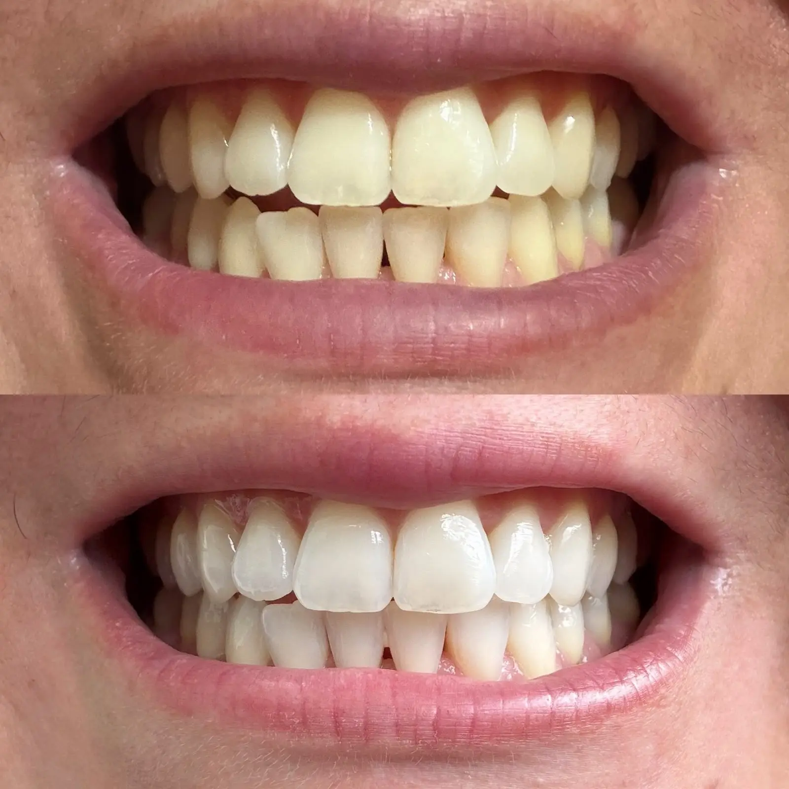 Detalhe de uma sessão de clareamento dental na OdontoVila